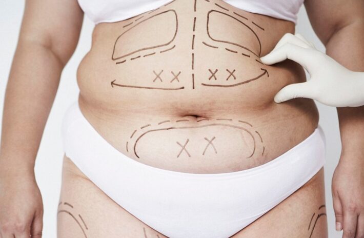 Liposuction vs Liposculpture – Which is The Right Treatment For You?
